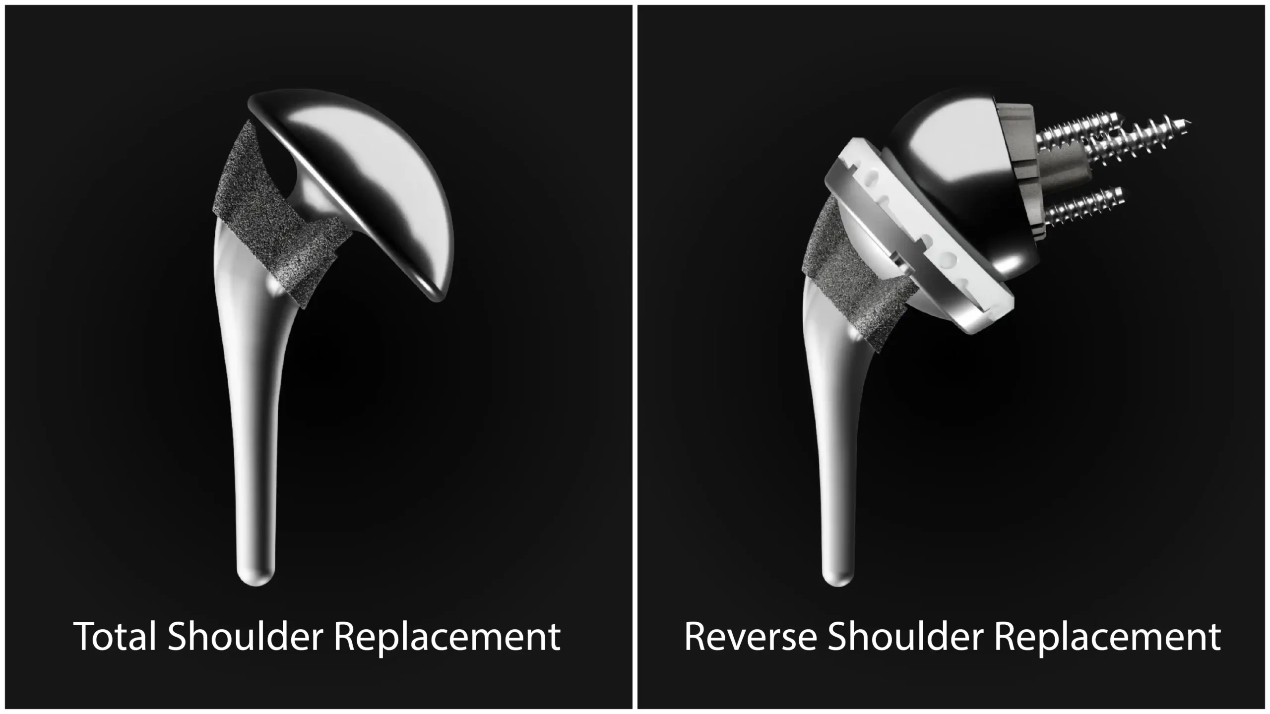 Successful Reverse Shoulder Replacement: TSA vs. RSA 