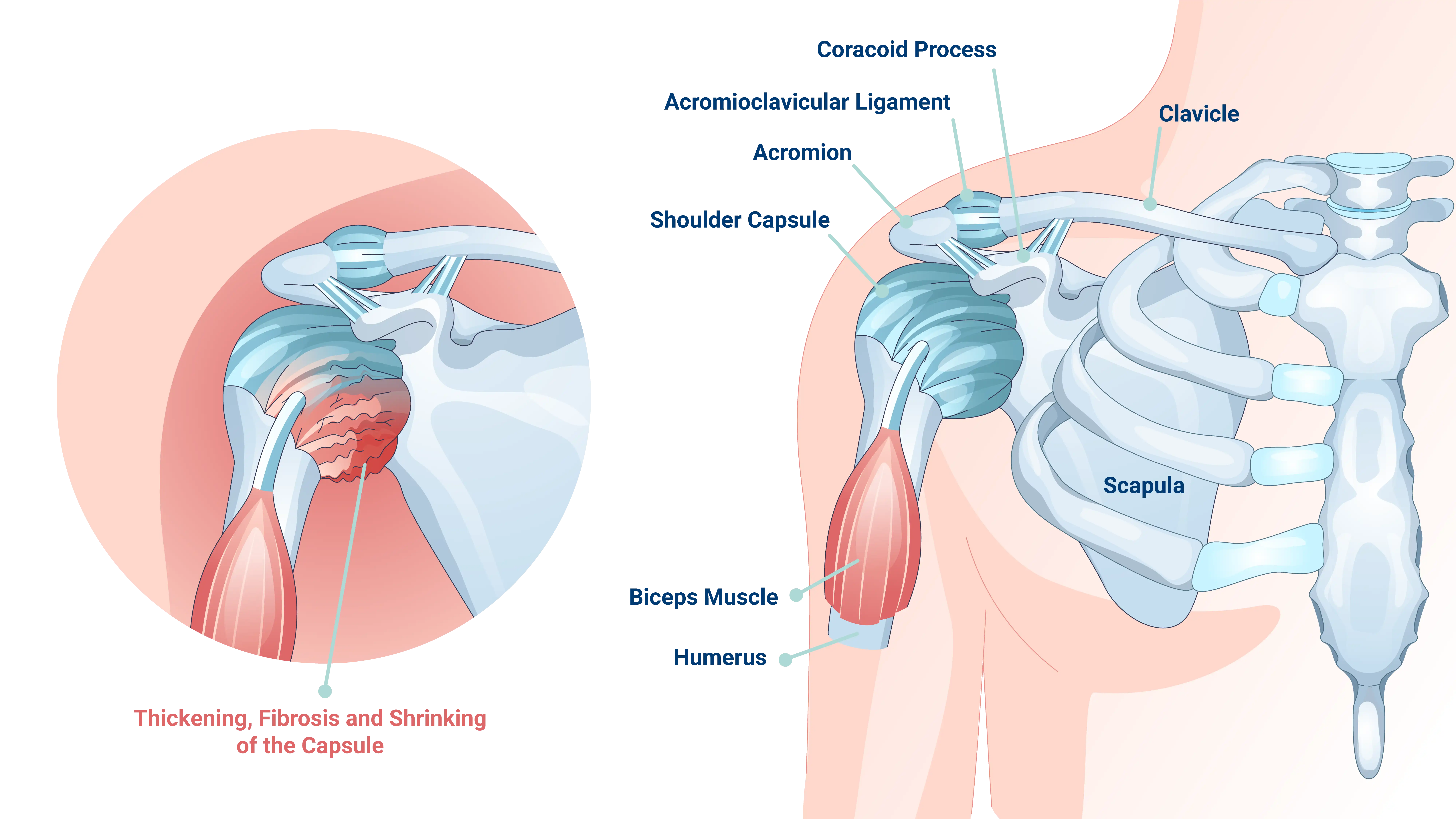 What is frozen shoulder?
