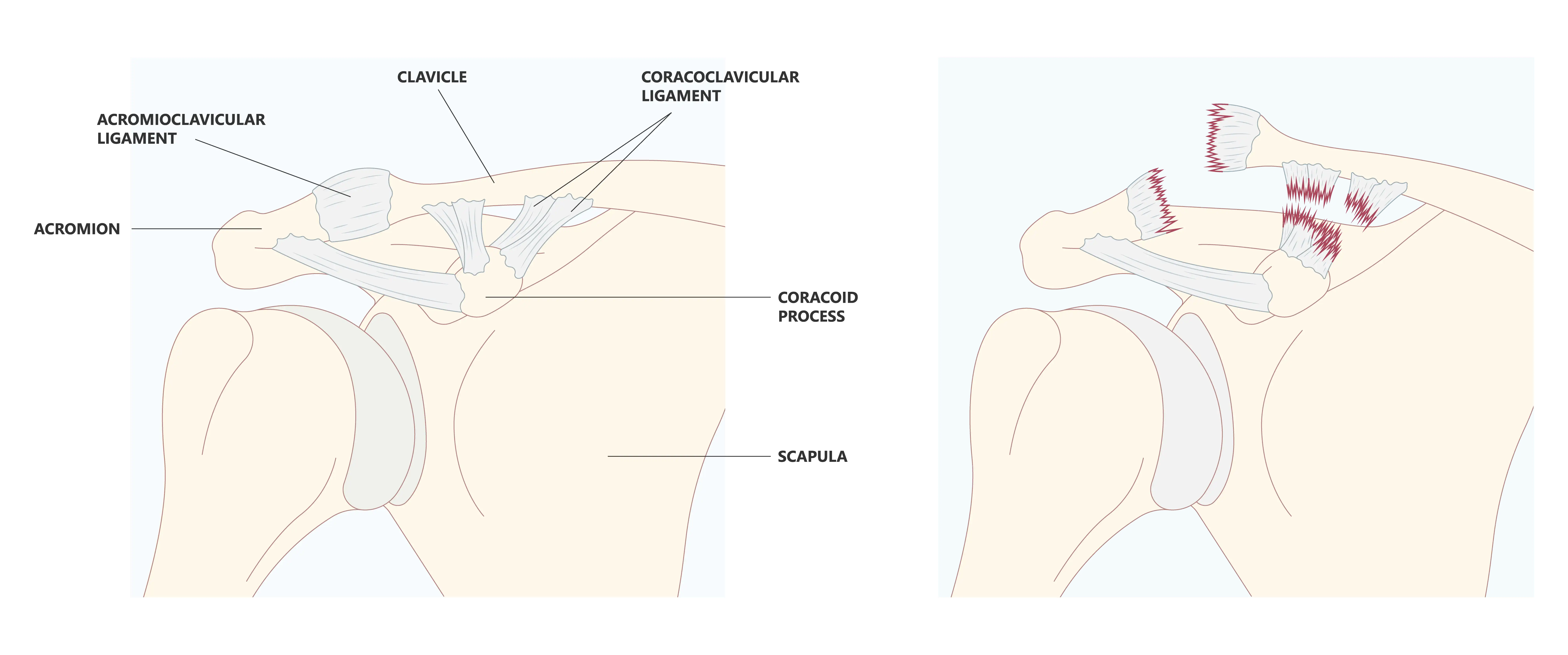 Anatomical Graphic AC Joint Tear