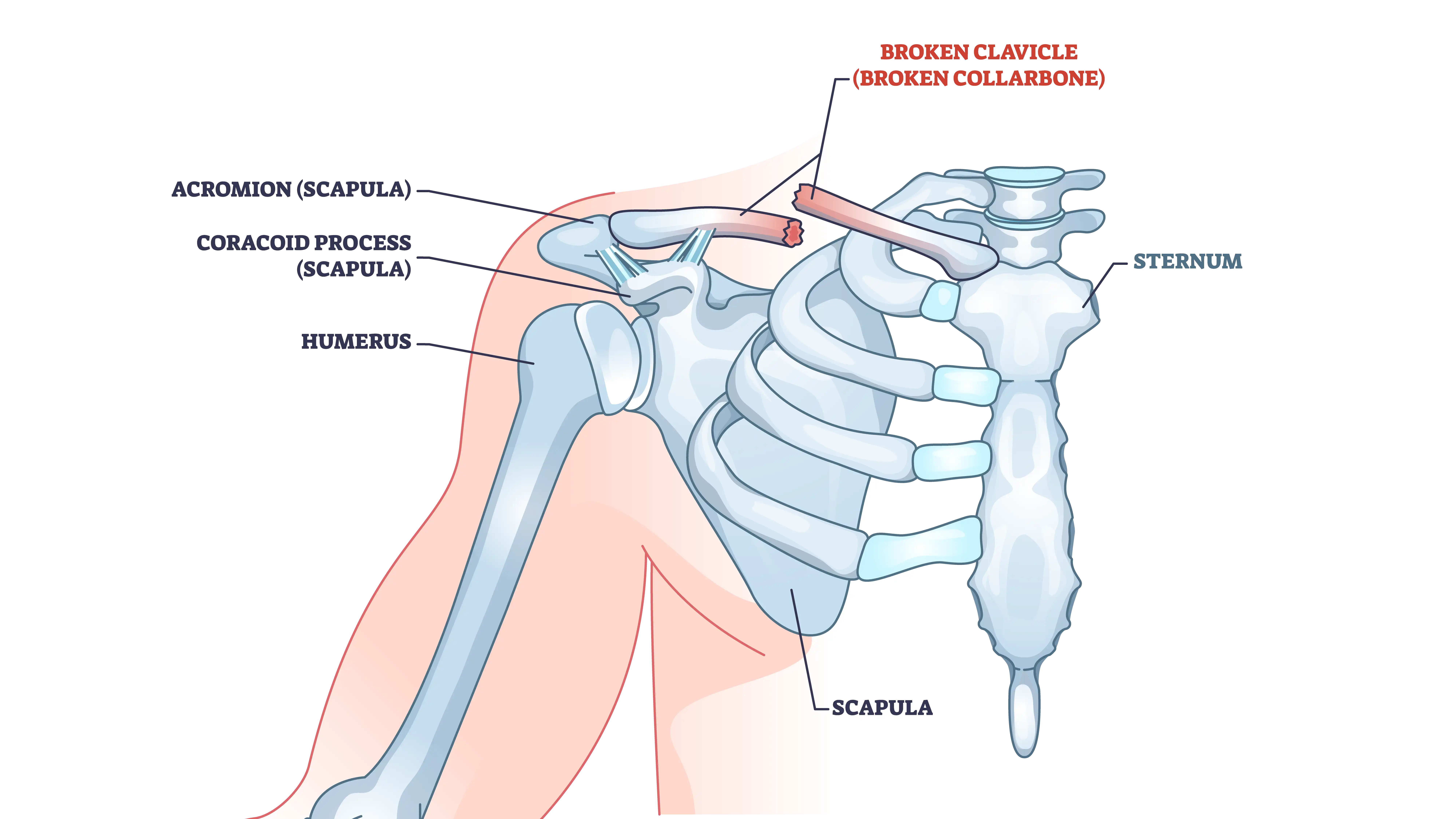 Anatomical graphic of broken clavicle