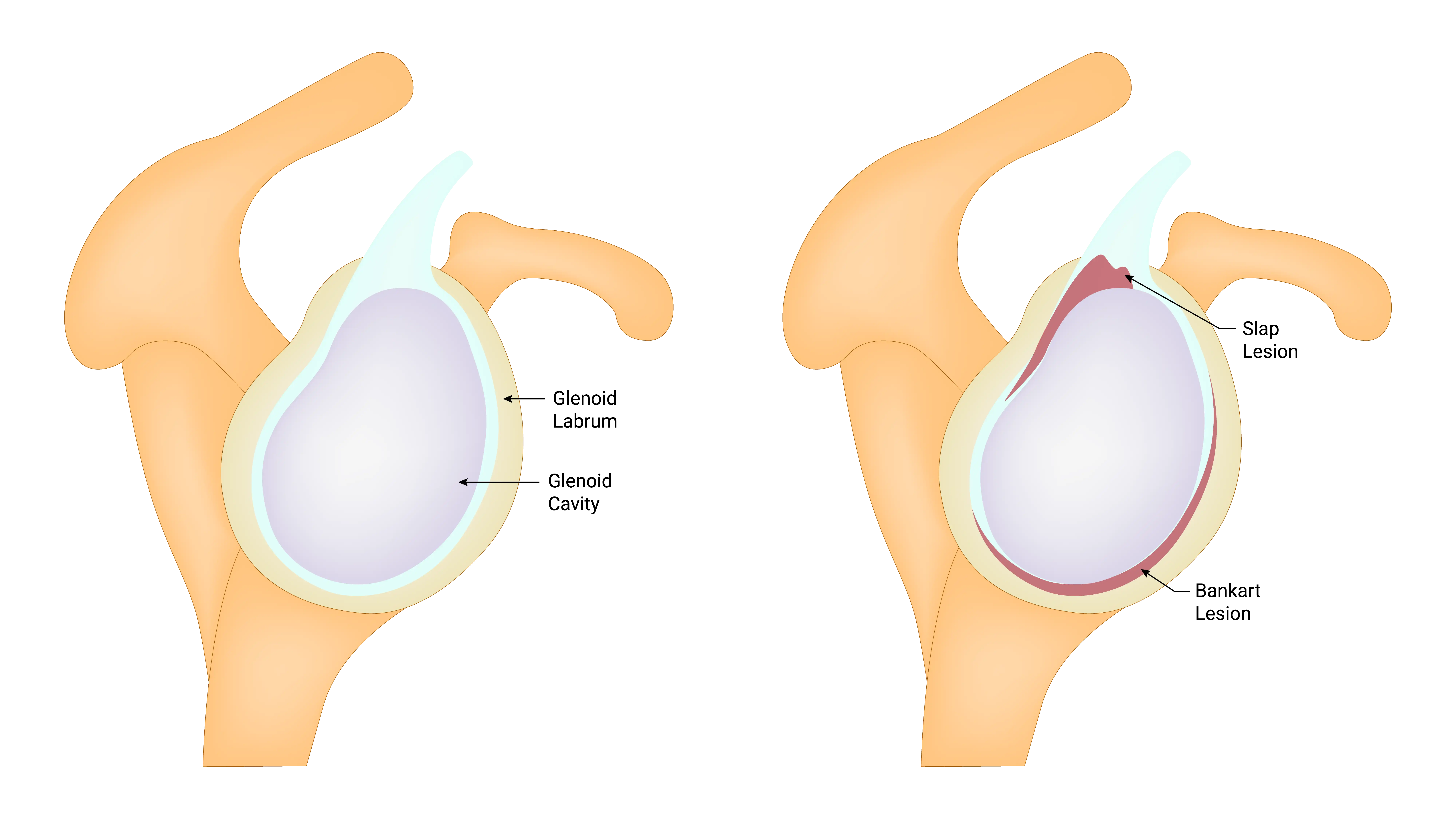 Anatomical Graphic of Labrum Tear