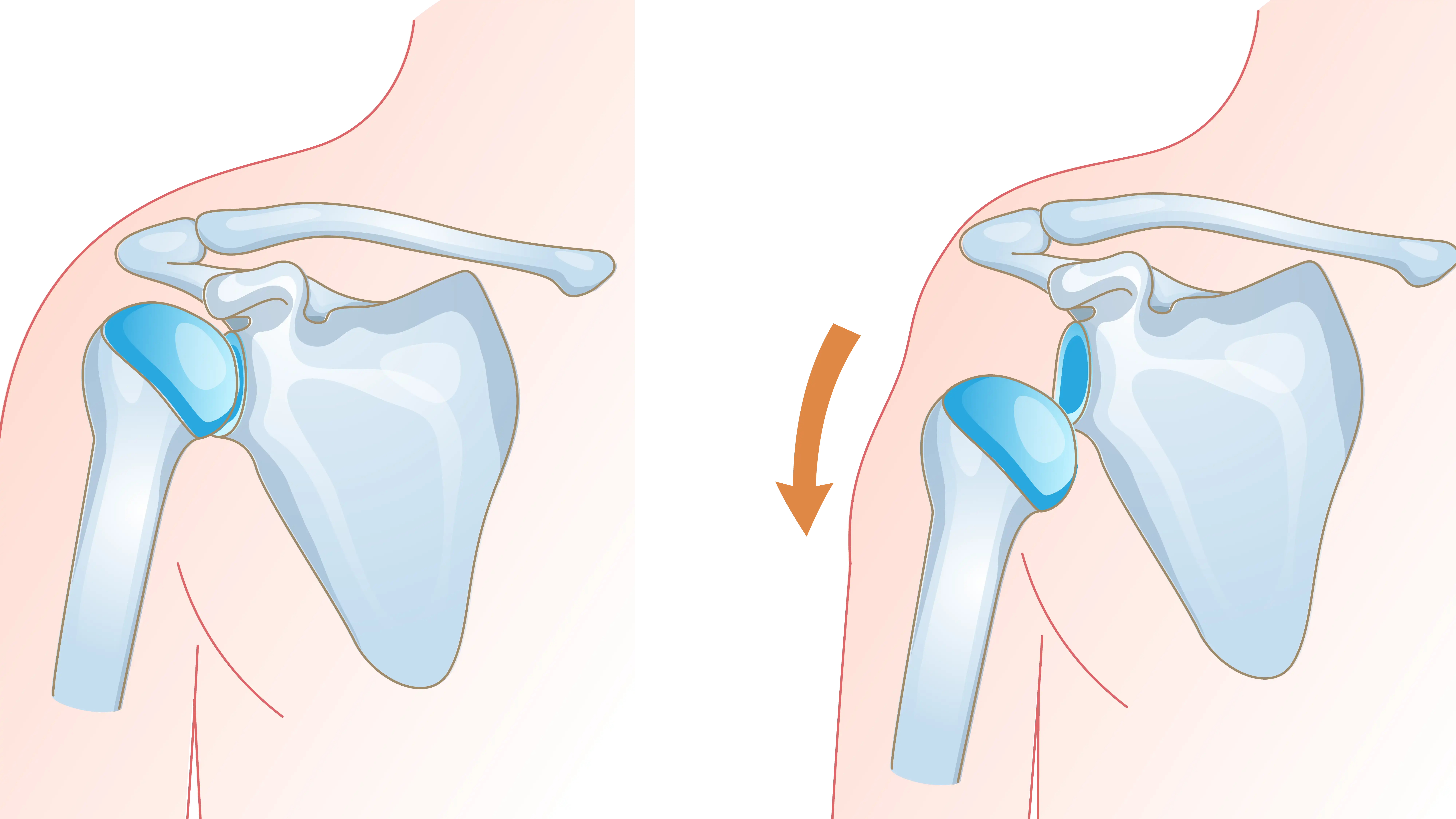 Anatomical graphic of shoulder dislocation